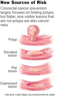 [ Colonoscopy must check for flat and depressed, not just raised lesions! Read article! ]