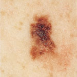 [ Leaern more about skin cancer! ]